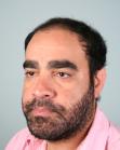 Before Hair Transplant&nbsp;2 Sessions (Areas)